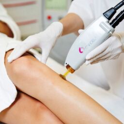 Laser Alexandrite Candela Pro: Όλα όσα πρέπει να ξέρετε!